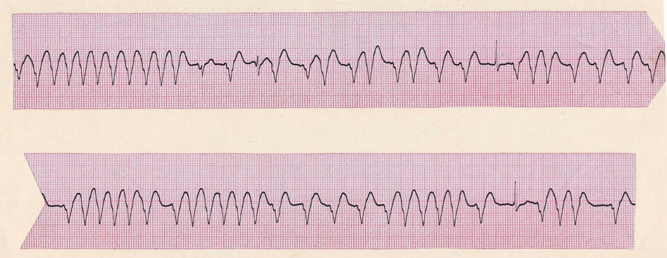 La siguiente tira de ritmo es muy característica de una arritmia determinada. ¿Podría decir cuál?