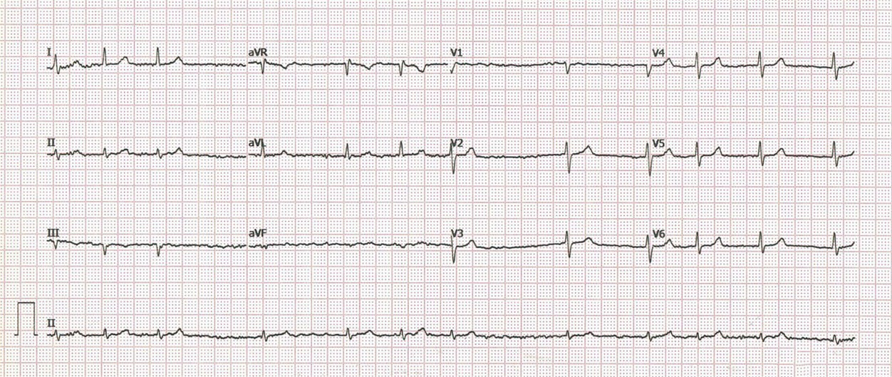 Este ECG pertenece a...