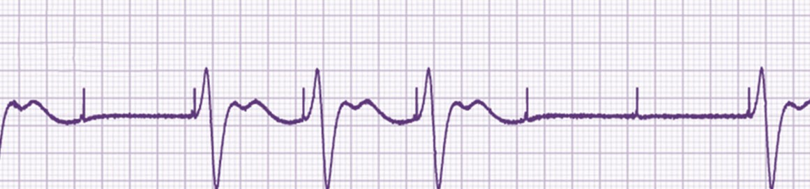 A la vista de esta tira de ECG, le parece que